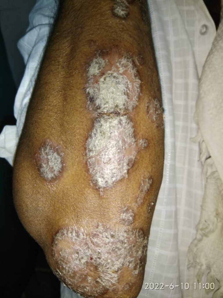psoriasis patient photo