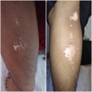 before and after image treatment of po